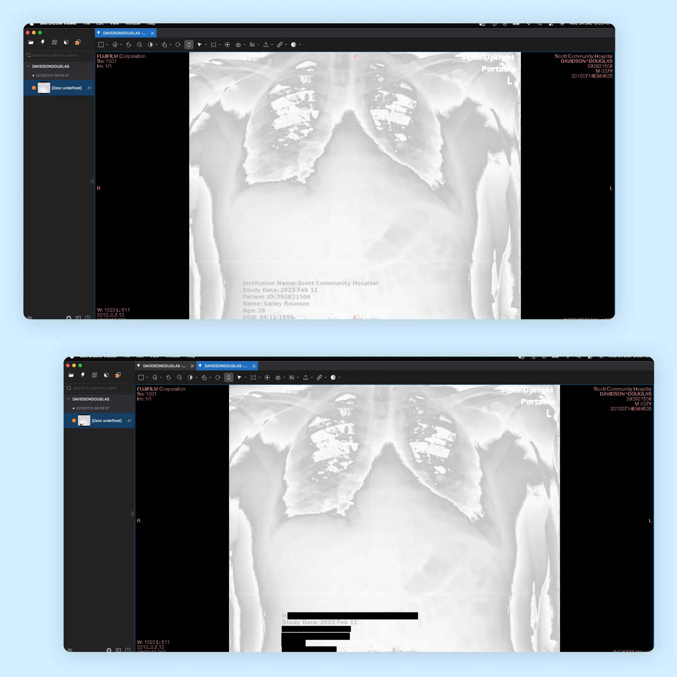 PHI redaction pipeline for medical imaging